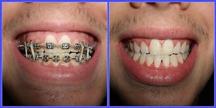 Which one is better: Invisalign or braces?