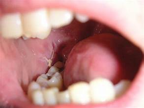 What are the things to know about tooth extraction? PIN