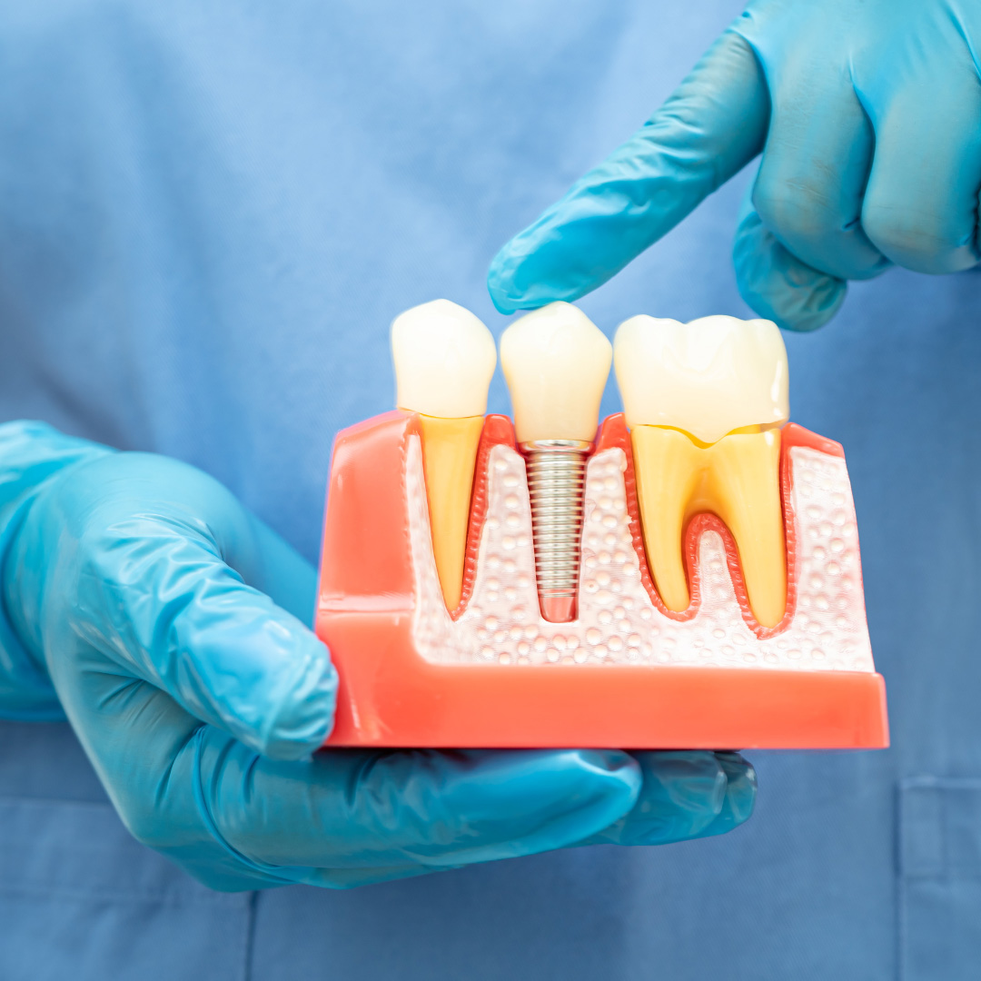 How to recover from a root canal treatment smoothly?
