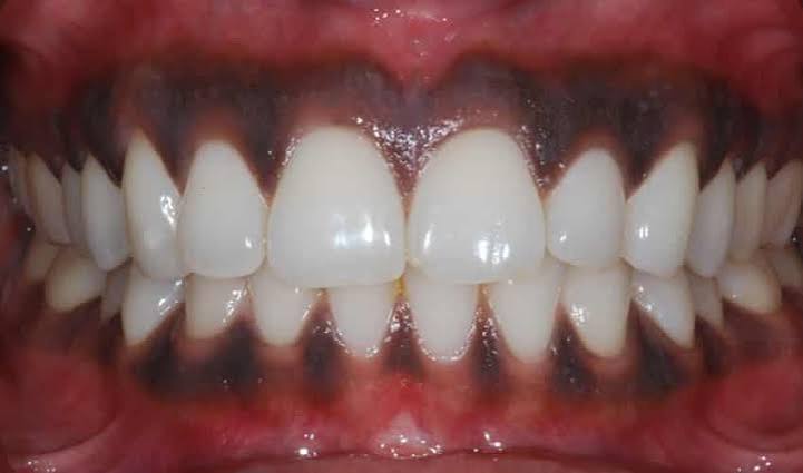 Black gum causes and treatments to know