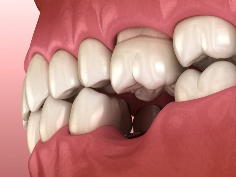 Tooth loss-common causes and the treatment options to know