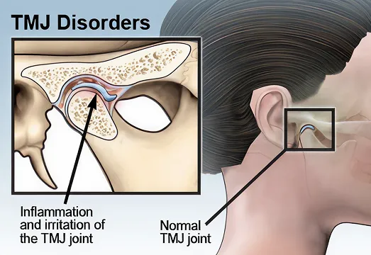 What are the things to know about open TMJ surgery?